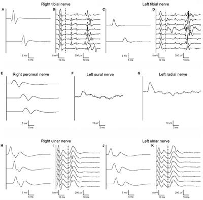 Frontiers | Atypical Electrophysiological Findings In A Patient With ...